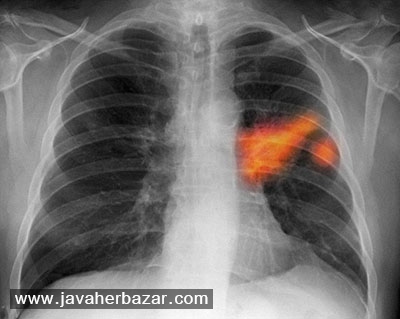 شناسایی سرطان به کمک الماس شناسایی سرطان به کمک الماس