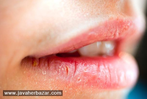 با آفتاب سوختگی لب چه کنیم؟ با آفتاب سوختگی لب چه کنیم؟
