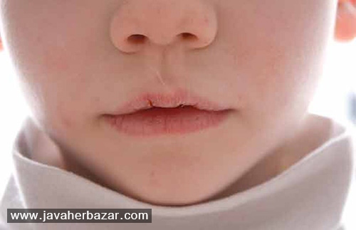 با آفتاب سوختگی لب چه کنیم؟ با آفتاب سوختگی لب چه کنیم؟